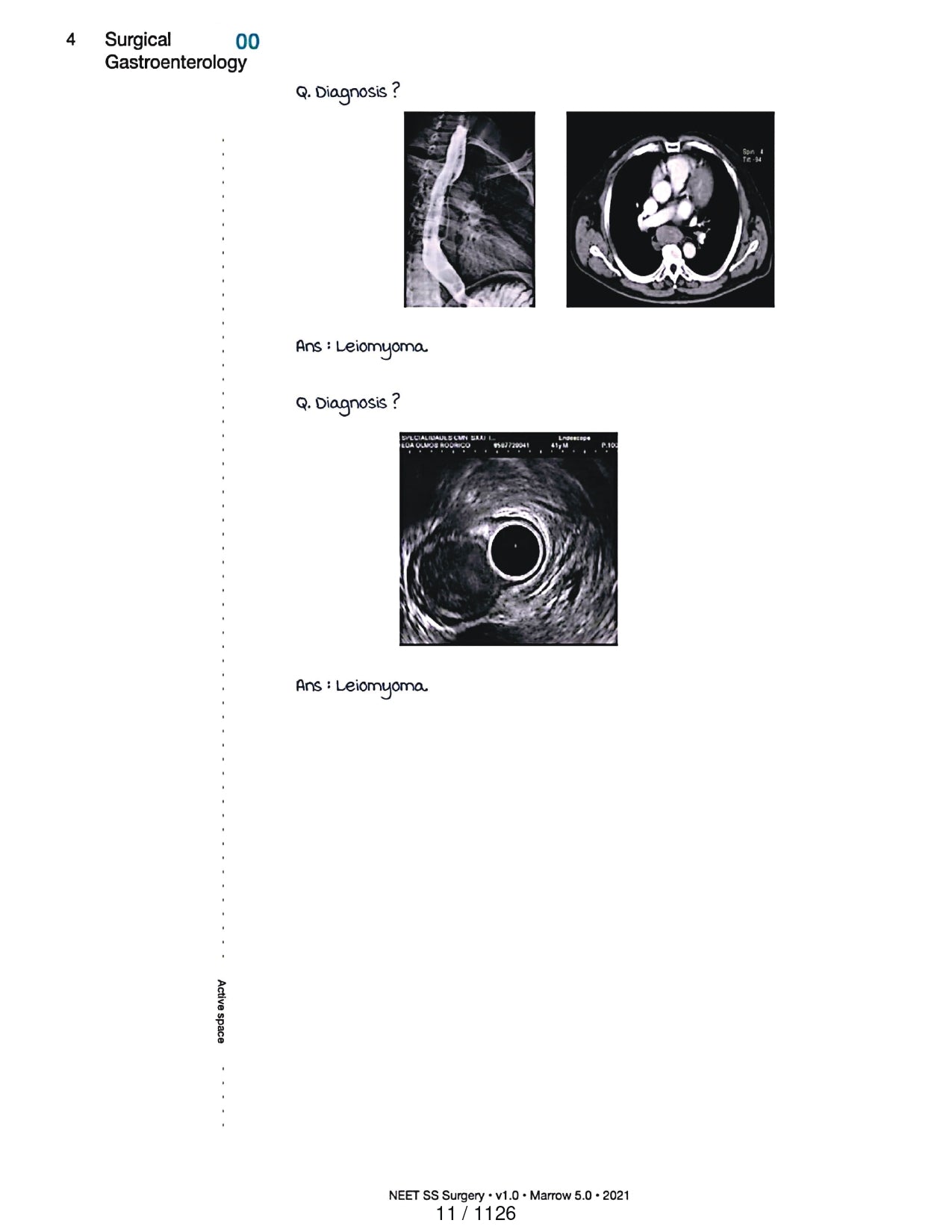 Surgery Neet SS - Gastro Surgery - PrintDoc