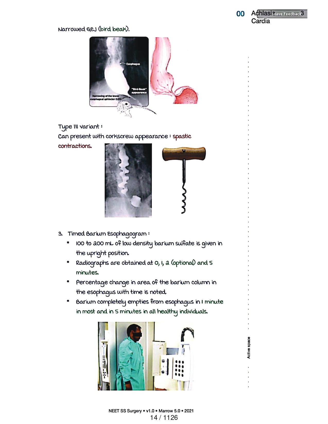 Surgery Neet SS - Gastro Surgery - PrintDoc