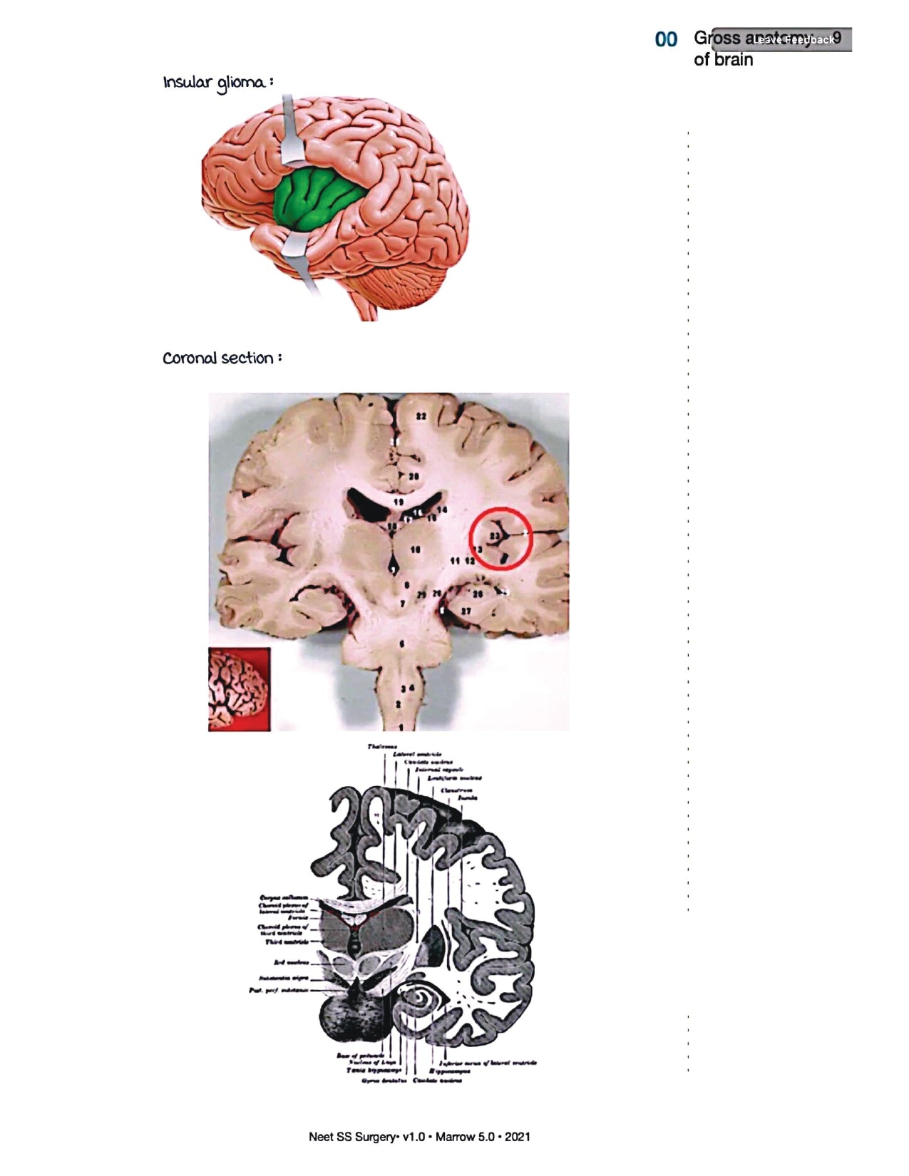 Surgery Neet SS - Neuro Surgery